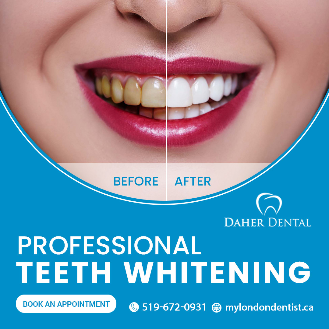 teeth whitening London Ontario
